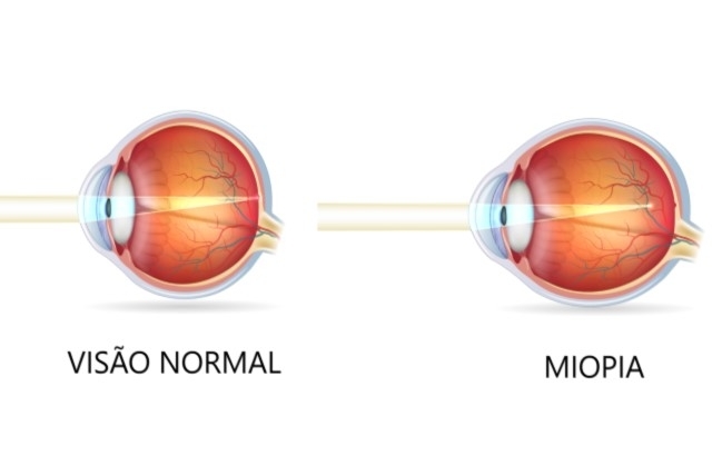 Visão normal e miopia